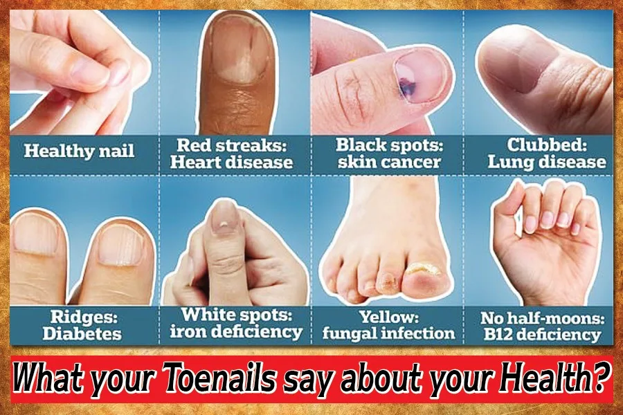 What your toenails say about your health?
